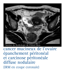 Les tumeurs rares de l'ovaire - IMAGYN